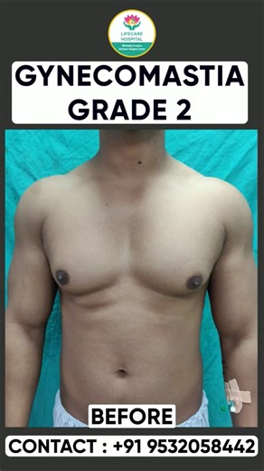 “Gynecomastia Surgery Before & After | Real Transformation ” #gynecomastiasurgery #beforeandafter