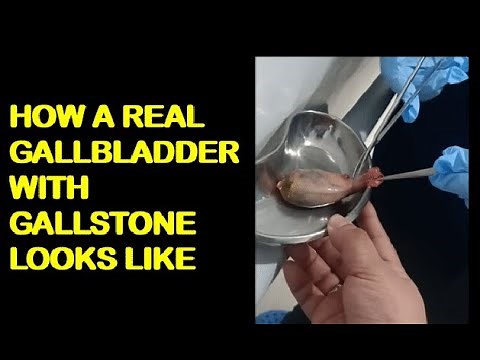 WATCH How Enlarged Gallbladder Looks Like!