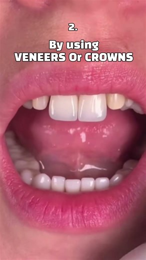 Dental black triangle makes you worry? #teeth #orthodontist #dentist #braces