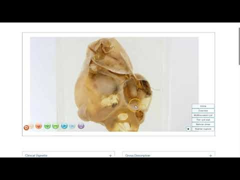 Ovary: Teratoma, mature cystic - Gross pathology