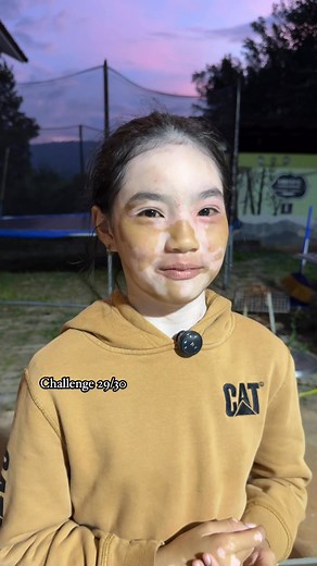 อากาศเปลี่ยนอย่าลืมดูแลสุขภาพด้วยนะคะ #RindaRadiant #น้องรินดา #vitiligo #ด่างขาว #สามใบเถา #challenge #30dayschallenge #khaoyai #เขาใหญ่อากาศดีมาก | Chotika Tipradarattanasiri