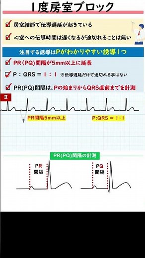 聞き流し1分心電図【1度房室ブロック】 #心電図検定