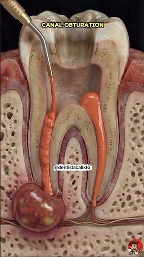 Como é feito o tratamento de canal segue vídeo revelando passo a passo desse mistério da odontologia