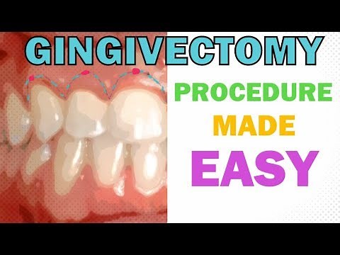 GINGIVECTOMY - PROCEDURE EXPLAINED IN 5 MINUTES - INDICATIONS, INSTRUMENTS, PROTOCOL, AFTER CARE