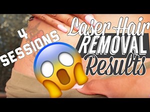 Bikini Laser Hair Removal | Visual Results after FOUR sessions