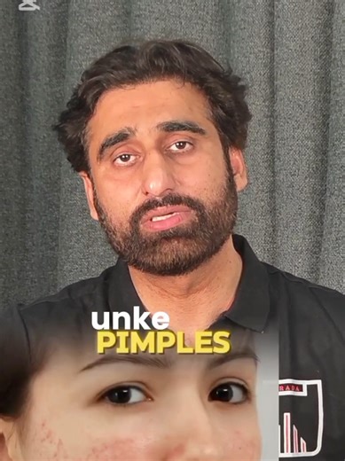 Does Toothpaste Treat Pimples?