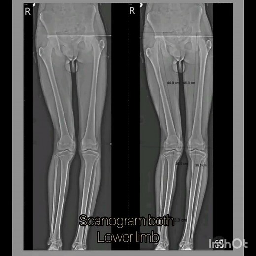 scanogram both lower limb #xrayroom #xray #radiology #xrayclasses #viralvideo #ytshorts #anatomy