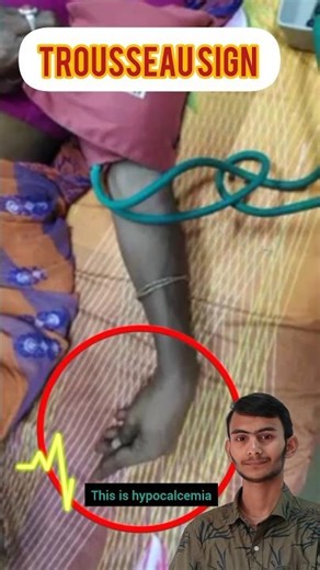 Trousseau Sign #shorts #viral #nursing