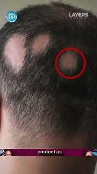 Difference between Seborrheic Dermatitis and Alopecia Areata | LAYERS Dr. Swathi Dermatologist