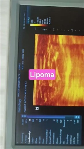Lipoma #ultrasound #Lipoma #mass