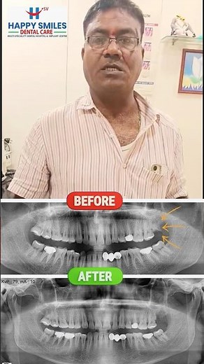 Painless Root Canal & Wisdom Tooth Treatment | Happy Smiles Review