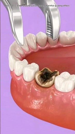 Tooth Extraction Procedure Explained Step-by-Step#toothextraction#DentalCare #dentalprocedure