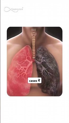Lung Surgery Explained: Types, Treatments & When They’re Needed 🫁 | Aapka Care