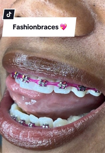 Fashion Braces for Style - Affordable Options Available