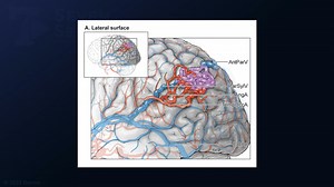 #184: Microsurgical Resection of a Lateral Parietal Arteriovenous Malformation - All Videos - Seven Series Collection