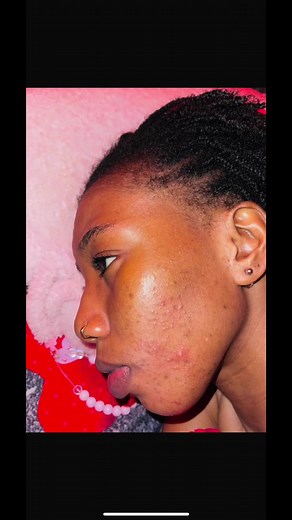 Epiderm Cream: Transform Your Skincare Routine