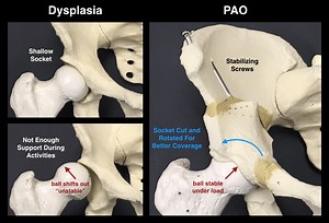 Periacetabular Osteotomy (PAO) | Hip Specialist | North Hollywood | Los Angeles Orthopedic Surgeon
