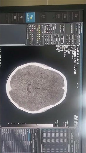 “Brain Hemorrhage on CT Scan 😨”“Stroke Patient CT Scan Explained!”“Normal vs Abnormal Brain CT!”