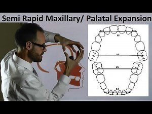 Mechanism of Semi Rapid Palatal/ Maxillary Expansion & Teeth Position on Arches by Dr Mike Mew