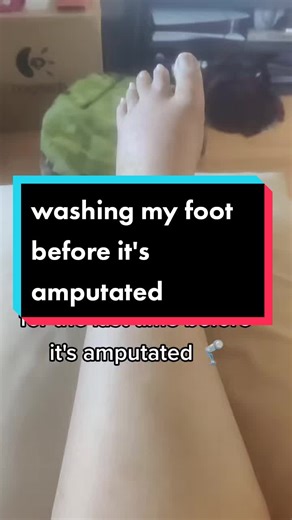 Finding Relief: Overcoming Foot Washing Dread with Amputation