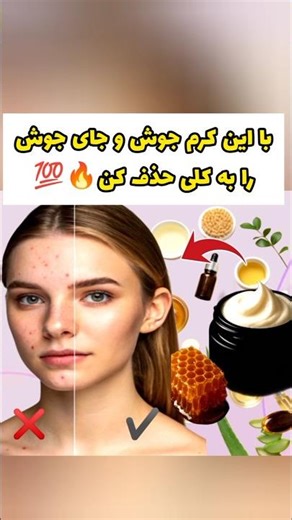 کرم ضدجوش خانگی برای درمان سریع جوش صورت و بدن ✨ ایده شغل خانگی پرسود