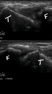 ATFL goes POP! #pocus #ultrasound #emergencymedicine #orthopedicsurgery