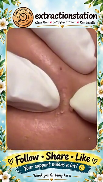 Deep Blackhead Extraction & Satisfying Popping | Wait for the most satisfying pop 😳🫣 You won’t believe what comes out! #pimplepoppersatisfying #Acne #pimple #Blackhead #Satisfying