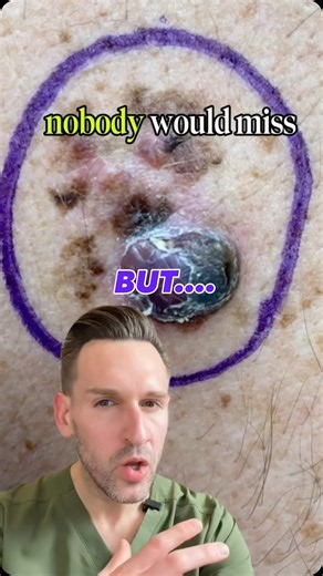 Michael Christopher MD on Instagram: "👀 Big, ugly lesion? Everyone sees it. 🫥 Tiny, “nothing” mole? That’s where we miss melanoma, and this is invasive melanoma as well. This video shows two invasive melanomas, one glaring, one invisible. Without dermoscopy, most clinicians would walk past it. 🔎 Dermoscopy = seeing beyond the naked eye. 🏥 Skin cancer screening with dermoscopy should be the standard of care. 📉 Invasive melanoma kills ~9,000 American lives e