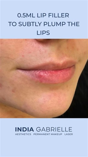 0.5ML Lip Filler subtle beautiful results by India Gabrielle 😍 #aesthetics #lipfillers #lipfillerbeforeandafter | The India Gabrielle Clinic