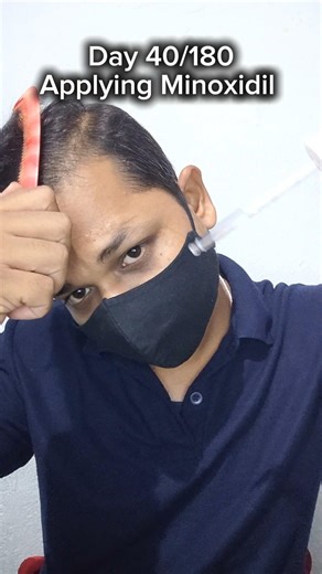 Day 40/180 of using Minoxidil | Hair shedding is very less now | #hair #minoxidil #minoxidilresult
