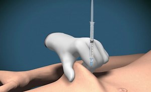 Subcutaneous injection animation demonstration