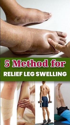 Leg Swelling? 5 Instant Relief Hack | Dr. Rohit Agrawal