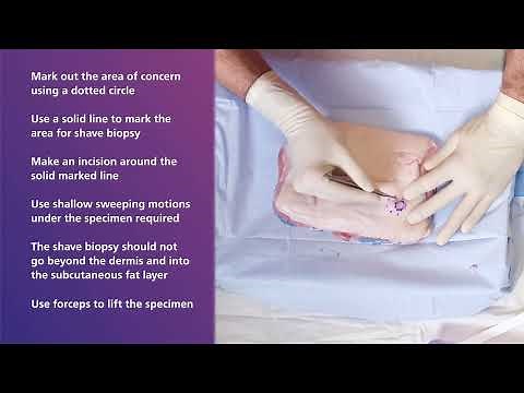 Shave Biopsy