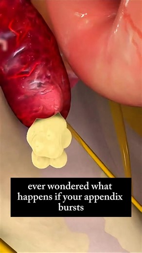 What Happens If Your Appendix Bursts? #shorts #youtubeshorts #ytshorts #shortsfeed #shortsvideo