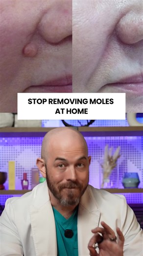 Professional Mole Removal: Avoid Home Scarring Risks