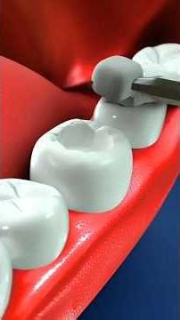Dental Fillings Explained: What Materials Are Best?