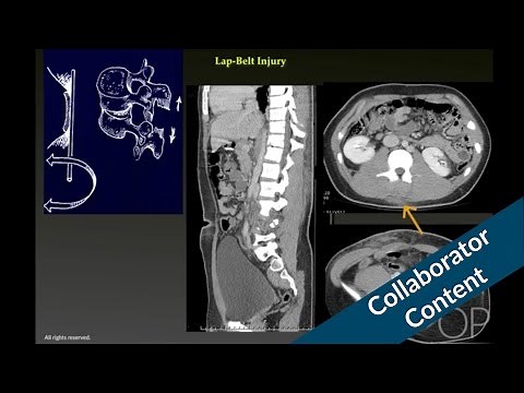 Bowel and Mesenteric Injury: High Risk Mechanisms and CT Findings by G. Taylor | OPENPediatrics