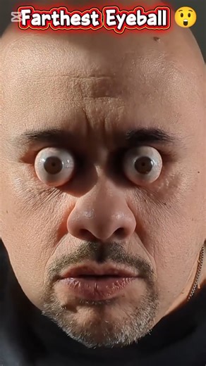 Farthest Eyeball Pop Ever Seen 😲 | Medical Health TV Official