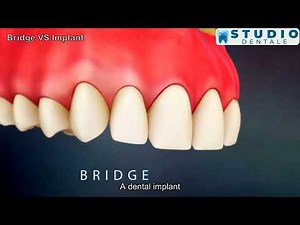 Bridge vs. Implant: Exploring Tooth Replacement Options |We Care Health Center | Studio Dentale
