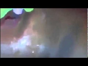 Strong pimple pus explosion reaches the wall !! 吹き出物, 面皰, 皮脂嚢胞 YouTube