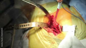 Surgical saw usage in hip replacement surgery (1080p, 25fps, sound)