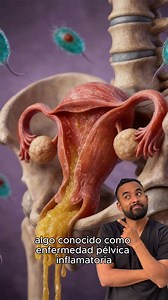 Enfermedad pélvica inflamatoria | Dr. Esteban Contreras