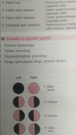 causes of pinpoint pupils #norcet10 #nclex #trending