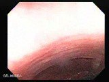 Colonoscopic Polypectomy (1 of 18) • Video • MEDtube.net
