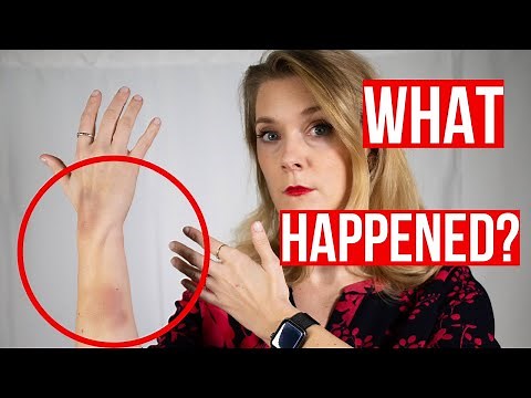 Explaining my bruises - Please keep asking!