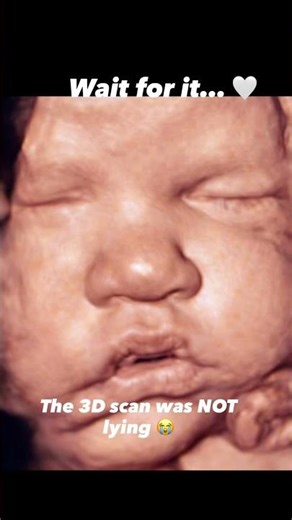 3D Ultrasound vs Real Baby Face — The Accuracy Will Shock You 🤯 #shorts