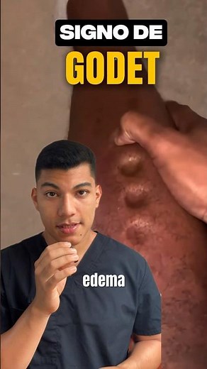 Godet's sign in EDEMA 🚨🚨 #edema #medicaldiagnosis #diagnosis