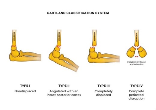 dr.sibcawilliam on Instagram: "●The Gartland Classification is a system for grading supracondylar humerus fractures in children, based on the degree of displacement and the integrity of the bone's posterior cortex. ●The classification has five types •Type I being undisplaced •Type II having intact posterior cortex despite displacement •Type III being completely displaced •Types IV and V representing increased instability This classification is vital for predicting the risk of associated neurovas