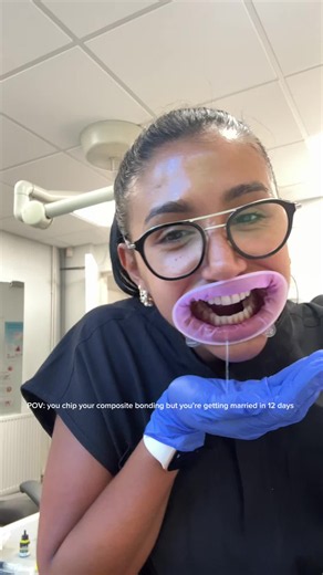 Composite bonding fix before wedding — 12 days to go!
