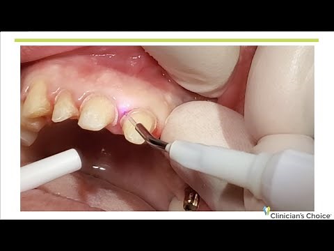 Laser Troughing with the Bluewave™ Soft Tissue Diode Laser. Dr. Ron Kaminer, DDS